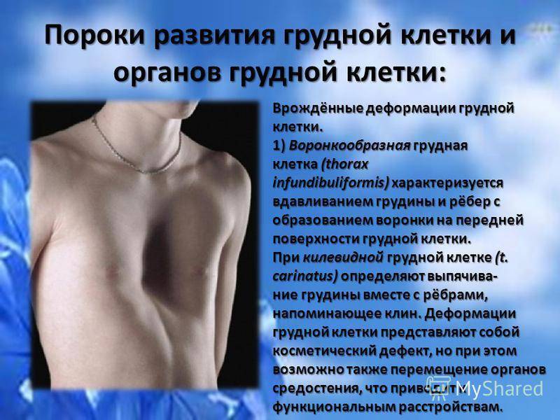 Воронкообразная деформация грудной клетки у детей: 7 причин, 4 симптома, 2 метода лечения