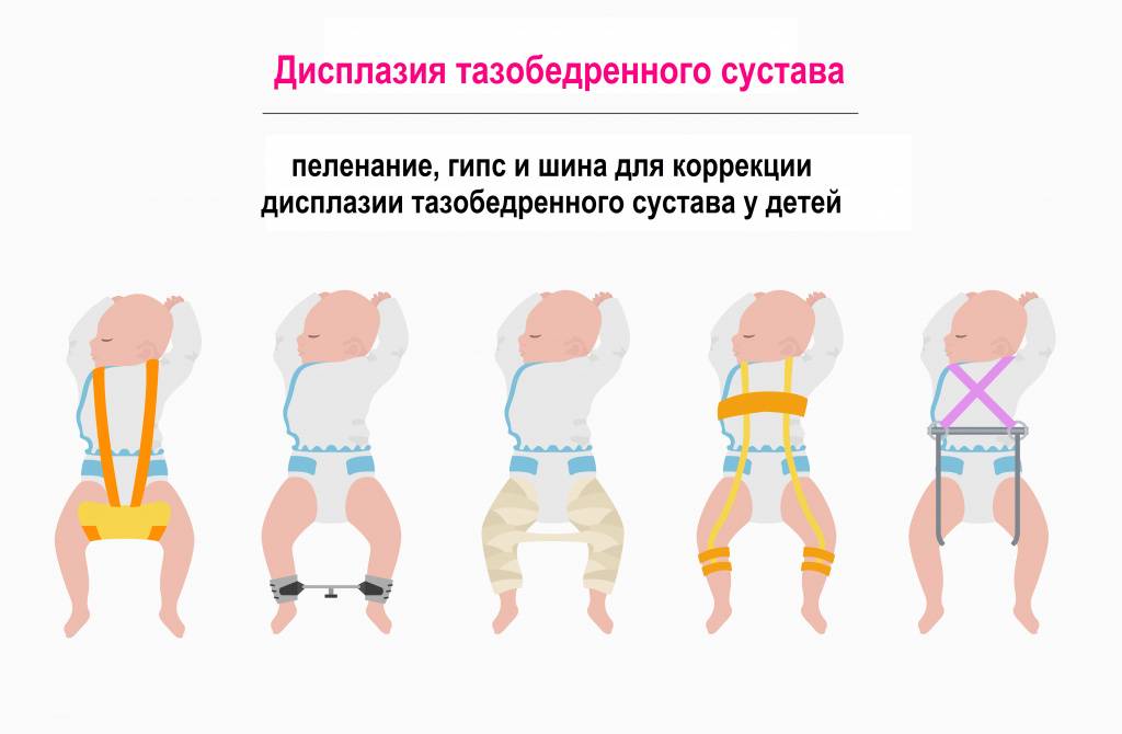 Дисплазия тазобедренного сустава | лечение дисплазии тбс у детей и взрослых ᐉ ladisten