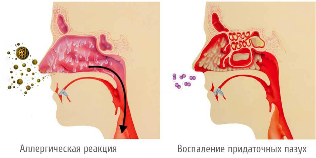 Носовое кровотечение у взрослого и ребенка: первая помощь