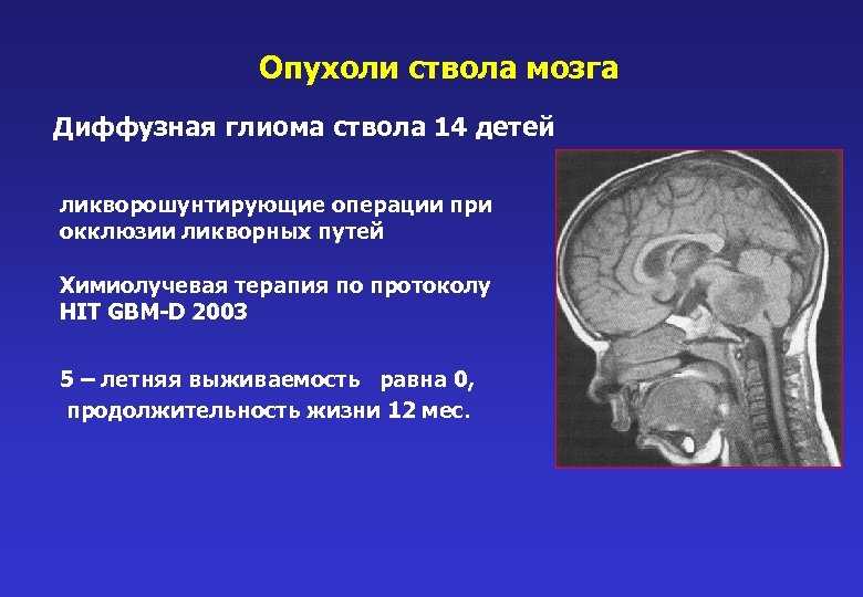 Опухоль мозга у детей