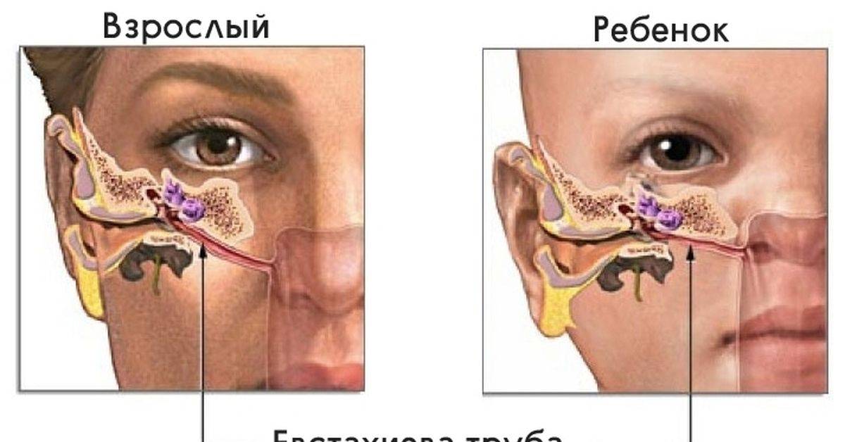 Шунтирование барабанной перепонки и аденотомия