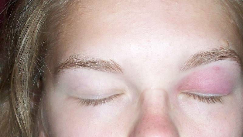 Опух глаз от укуса комара у ребенка