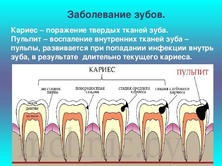 Удаление коренных зубов