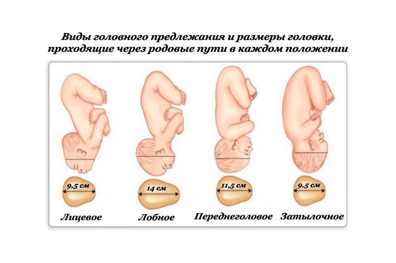 Что такое предлежание плода: виды, положение ребенка в матке по неделям беременности, перед родами