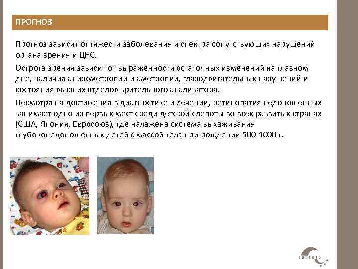 Ретинопатия у недоношенных детей: стадии и степени, причины, симптомы, диагностика и лечение, последствия и профилактика + фото