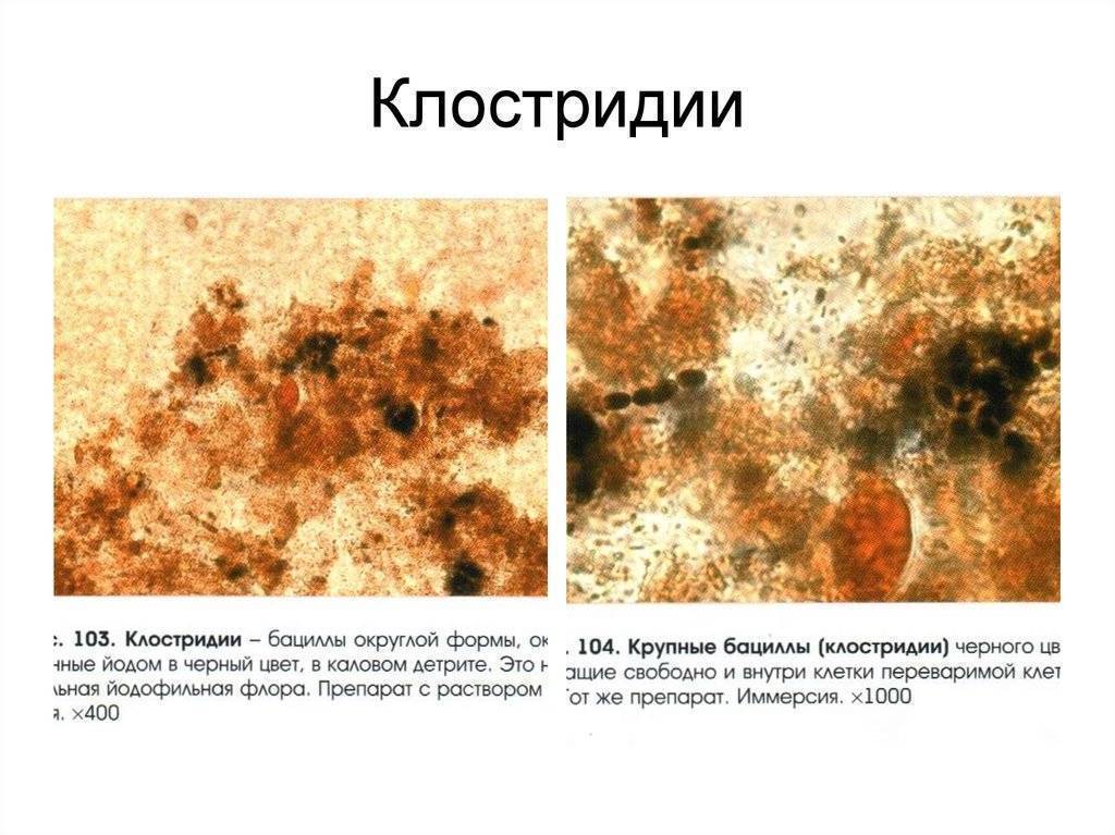 Йодофильная флора в кале у взрослого и ребенка: что это значит, причины и лечение
