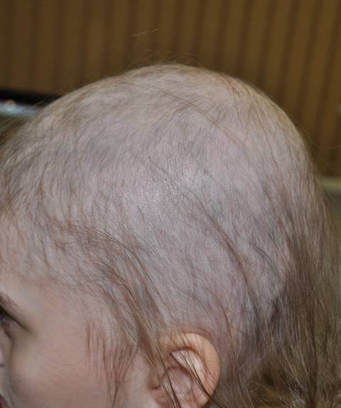 Почему у ребенка очень плохо растут волосы, выпадают: причины и коррекция проблемы у грудничков и детей постарше