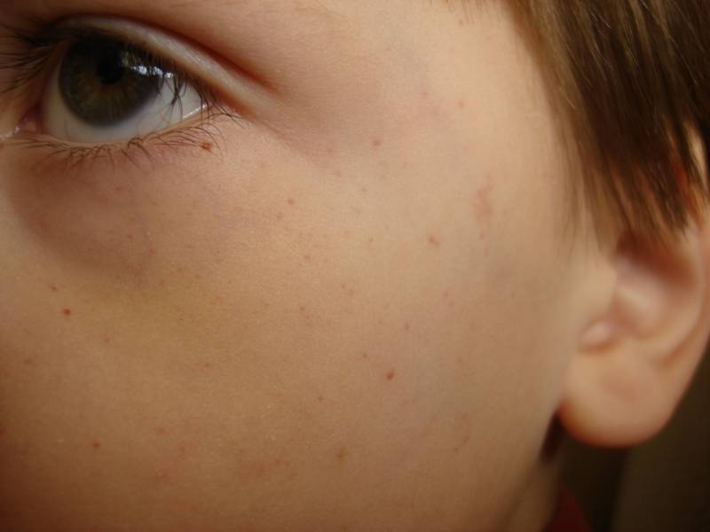 Красные точки вокруг глаз у детей и взрослых - причины, лечение