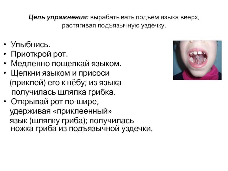Короткая уздечка языка. подрезать или растягивать?