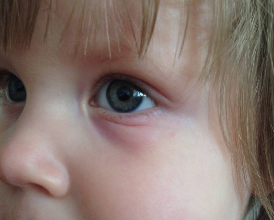 Красные круги под глазами у ребенка, мелкие точки или пятна - причины возникновения