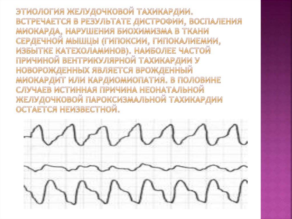 Тахикардия у детей