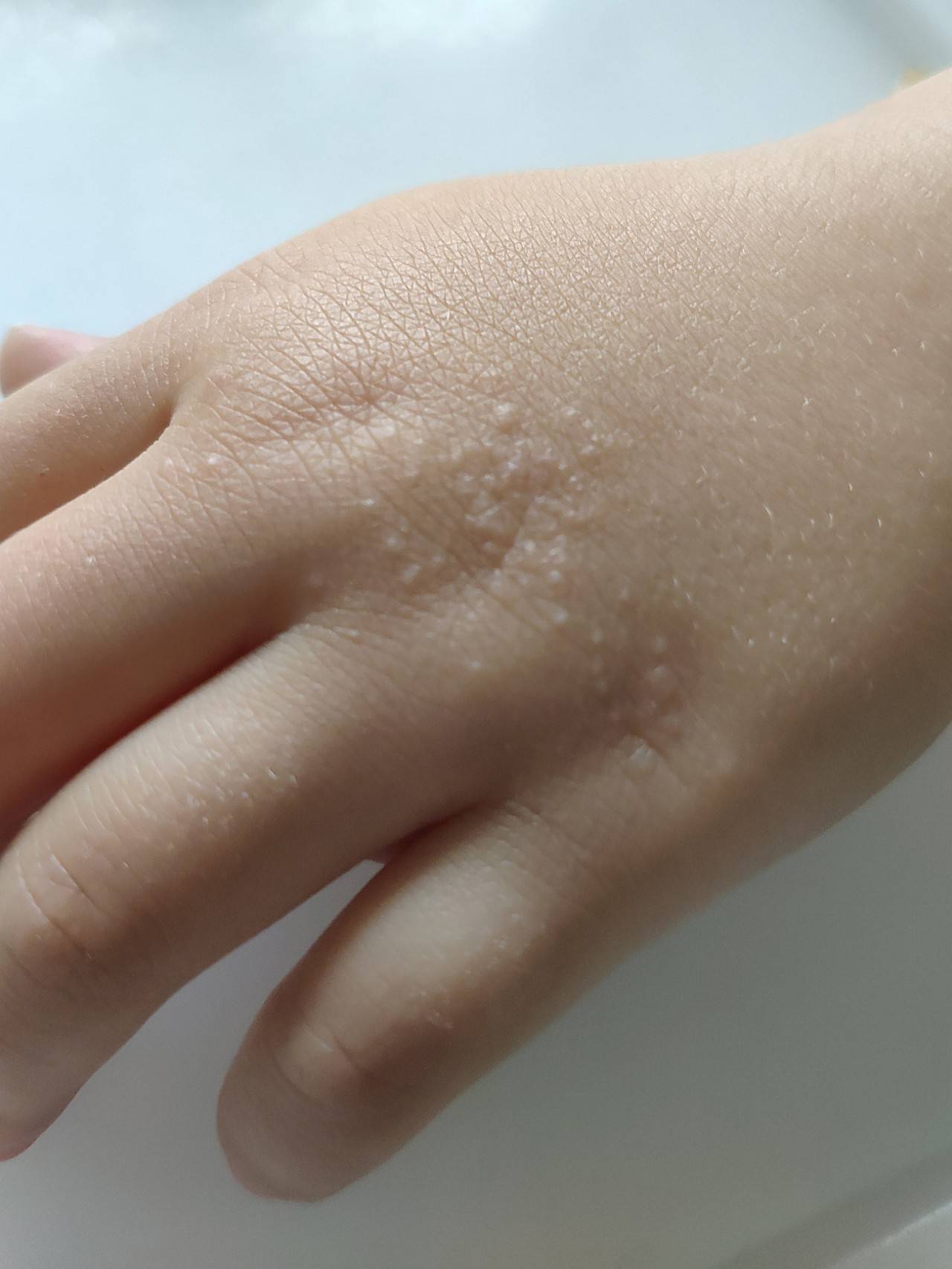 Сыпь на теле у ребенка 👶 - фото с пояснениями: мелкая, похожая на мурашки, красная и без зуда