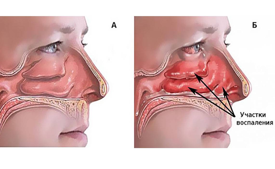 Как избавиться от отека носа у детей: причины и эффективное лечение