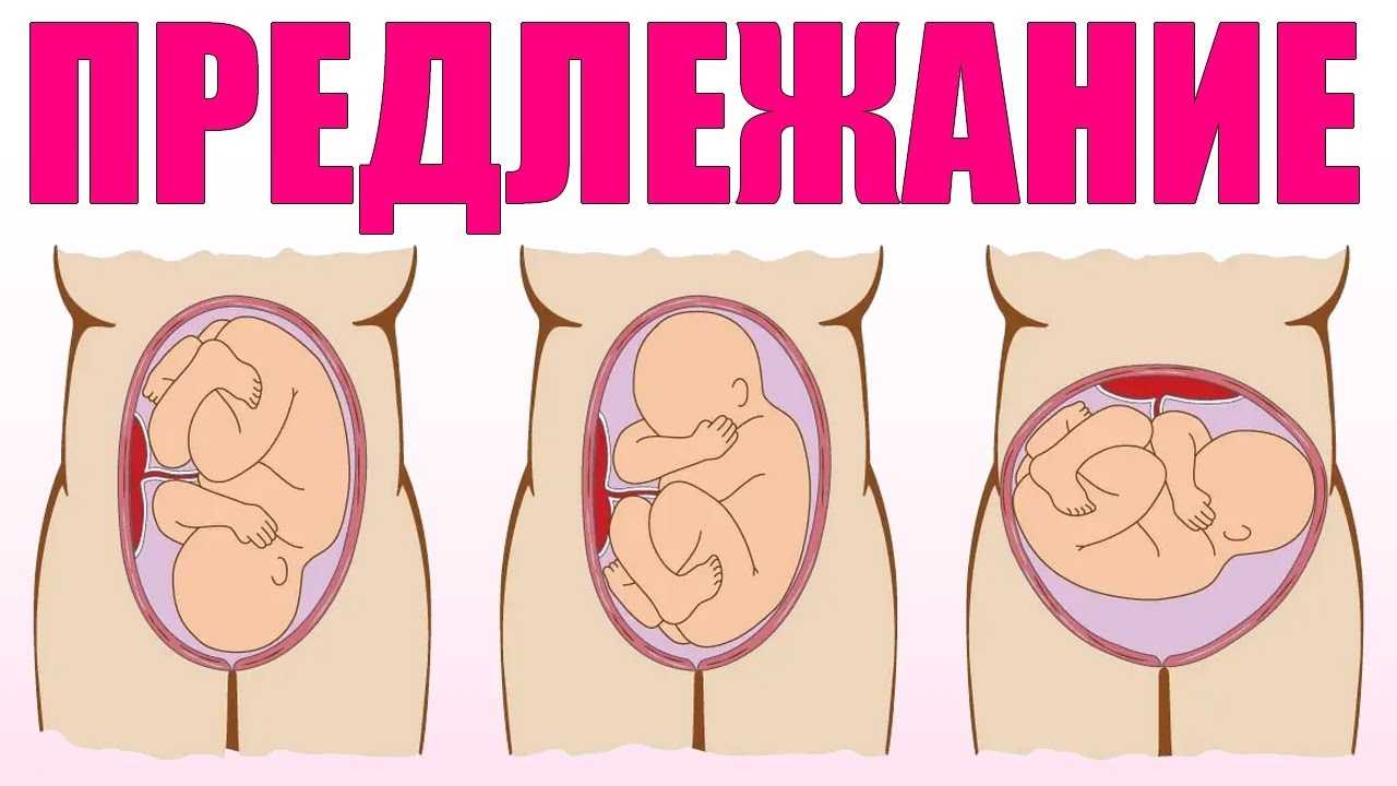 Низкая плацентация – не диагноз, но предупреждение