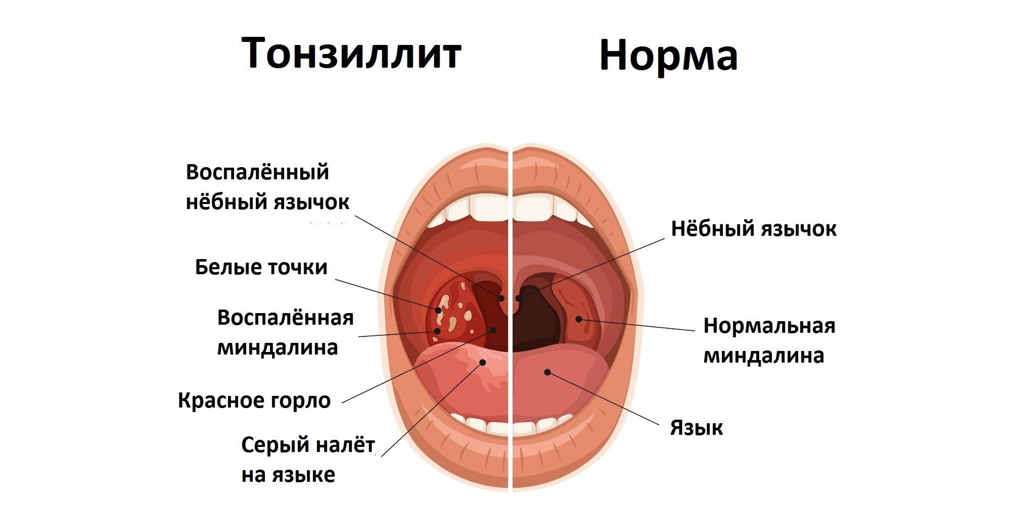Ангина у детей – симптомы и лечение. как и чем лечить ангину у ребенка - здоровье человека, симптомы и лечение заболеваний