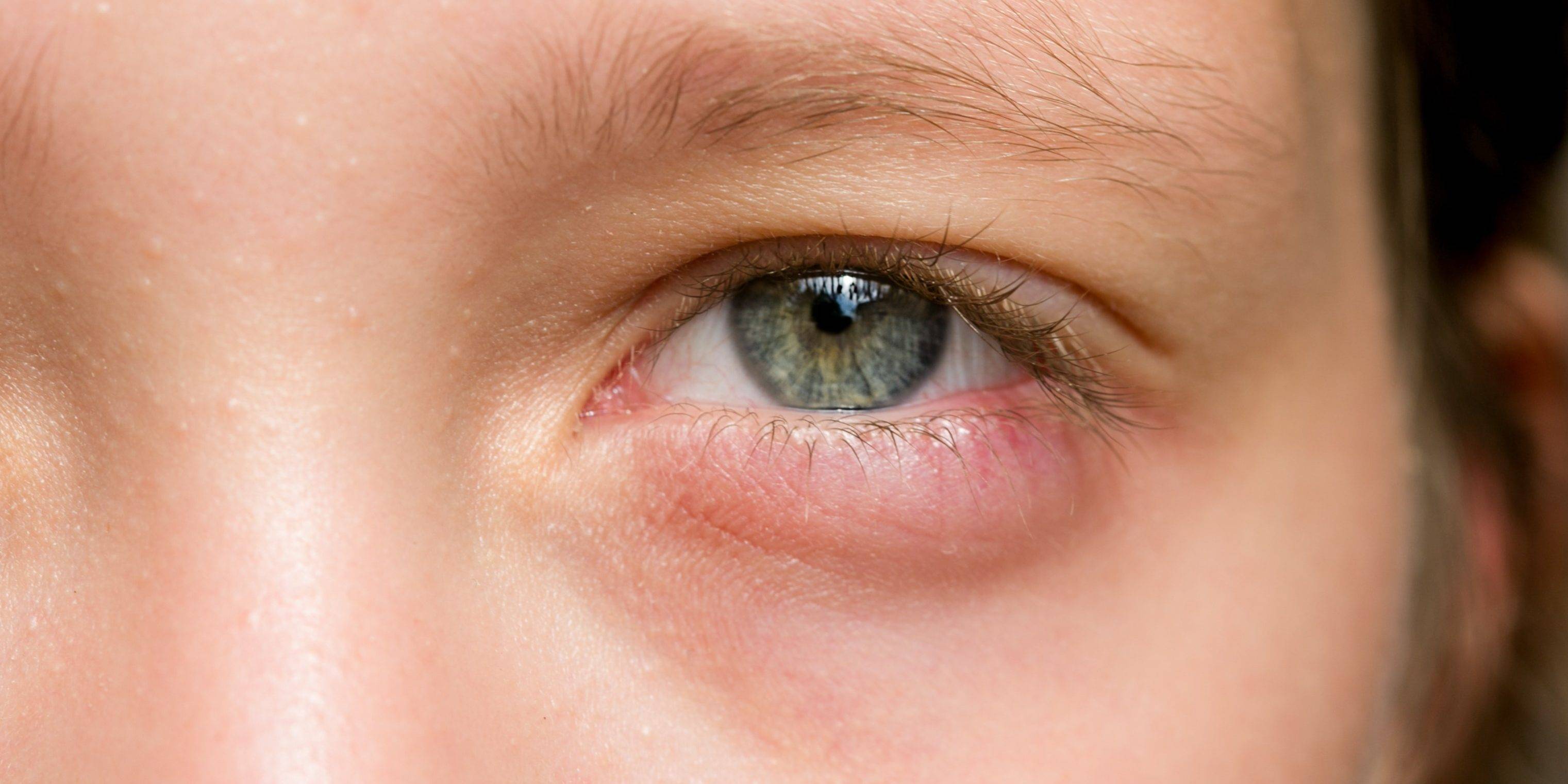Красные глаза у детей