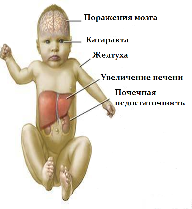 Норма галактозы в крови новорожденного
