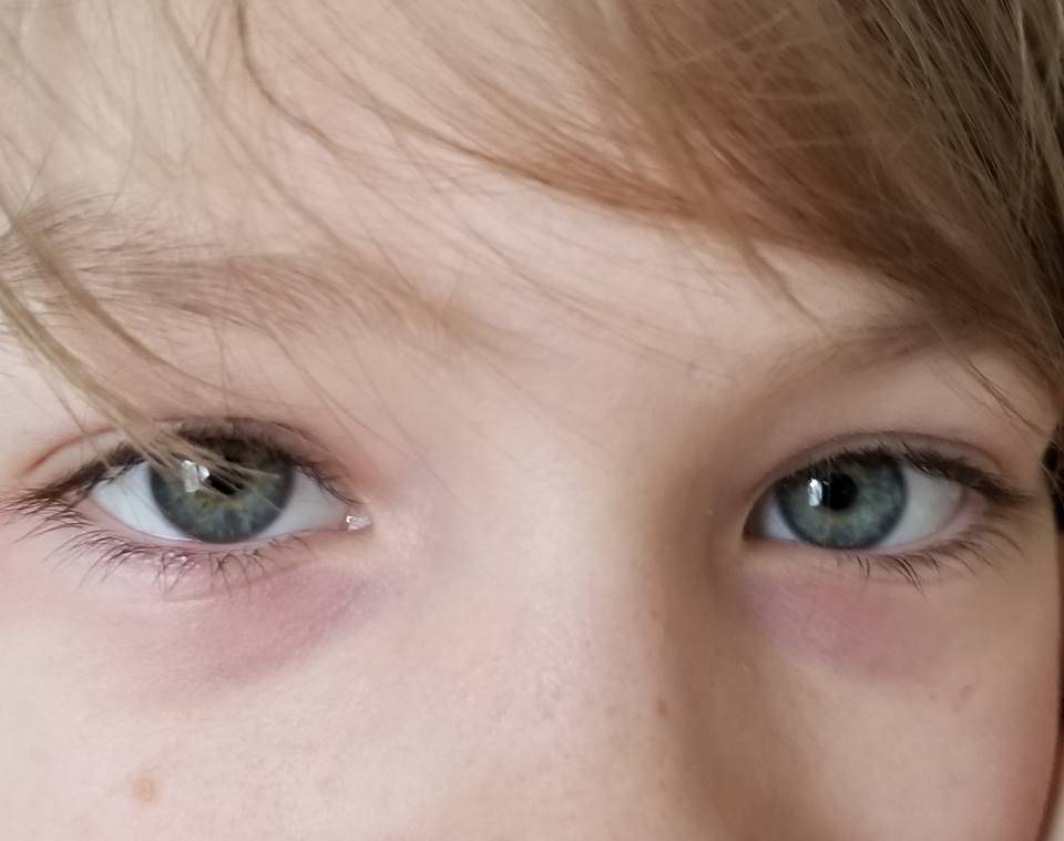 Круги под глазами у ребенка — причины и способы помощи