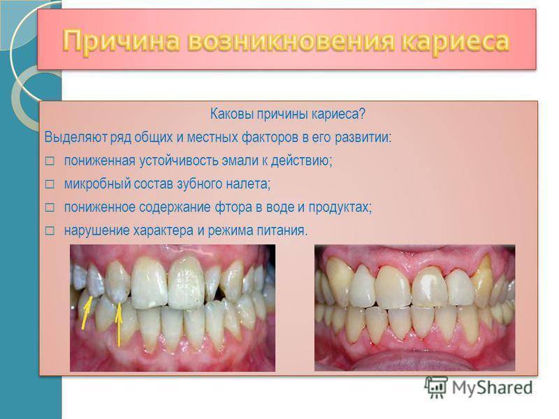 Зубной камень у детей: причины и удаление - underson clinic