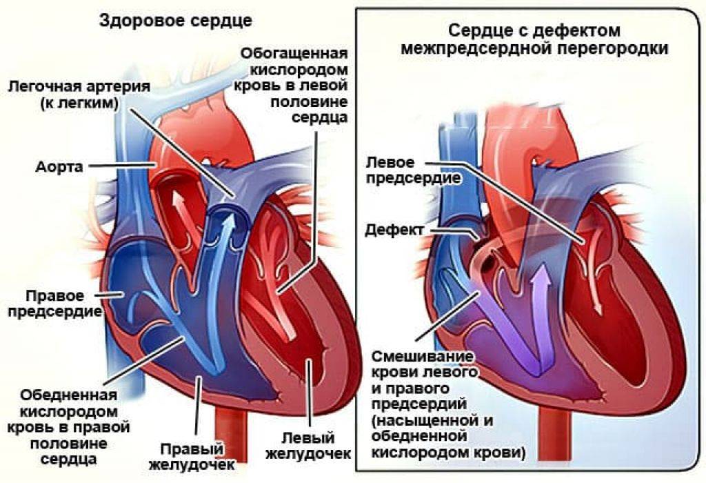 Дефект межпредсердной перегородки (дмпп):у детей, новорожденных и взрослых