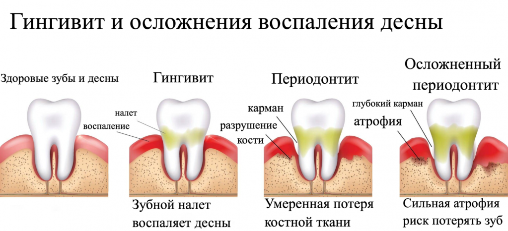 Гингивит у детей