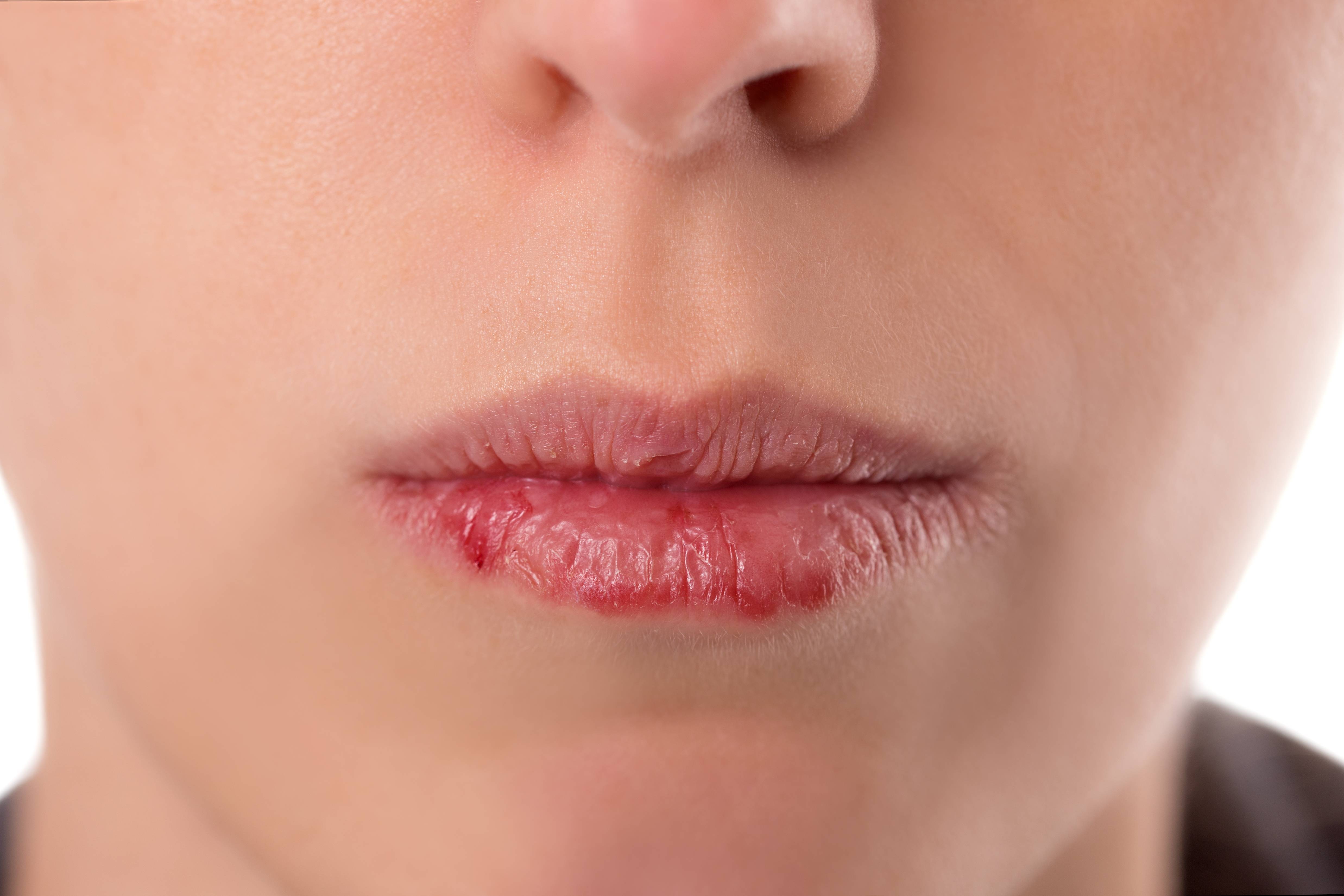 Заеды и трещины в уголках рта (ангулит, ангулярный хейлит, ангулярный стоматит). причины, виды, симптомы и лечение заед на губах у ребенка, у взрослых
