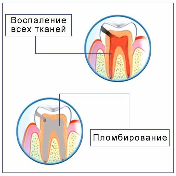 Серебрение молочных зубов у детей | лечение кариеса серебрением