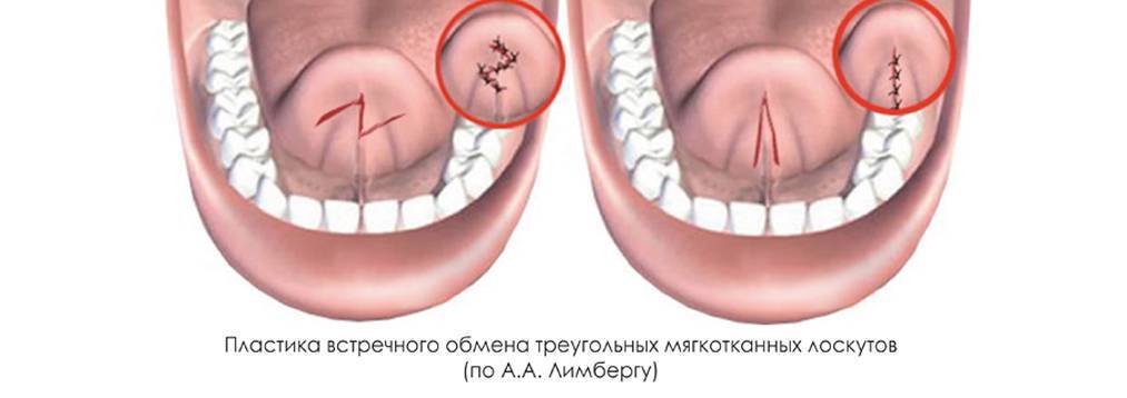 Возрастные ограничения при обрезке уздечки: до скольки лет можно проводить процедуру?
