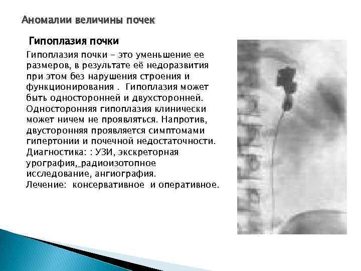 Гипоплазия почки (двусторонняя гипоплазия) - что это такое?