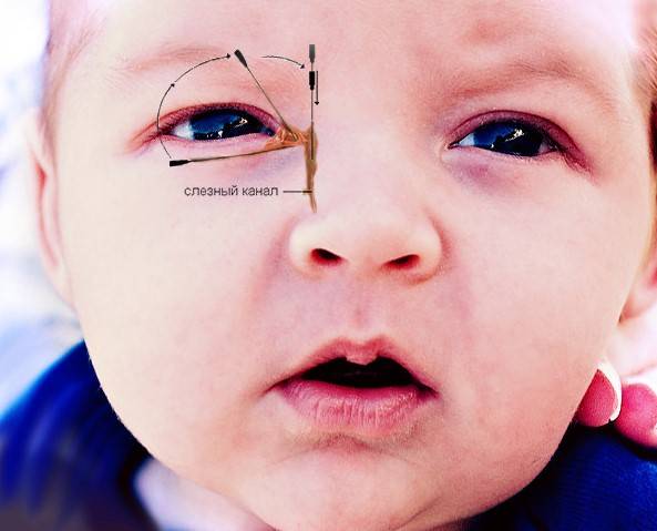 Дакриоцистит глаз у новорожденных: фото, лечение и массаж от комаровского