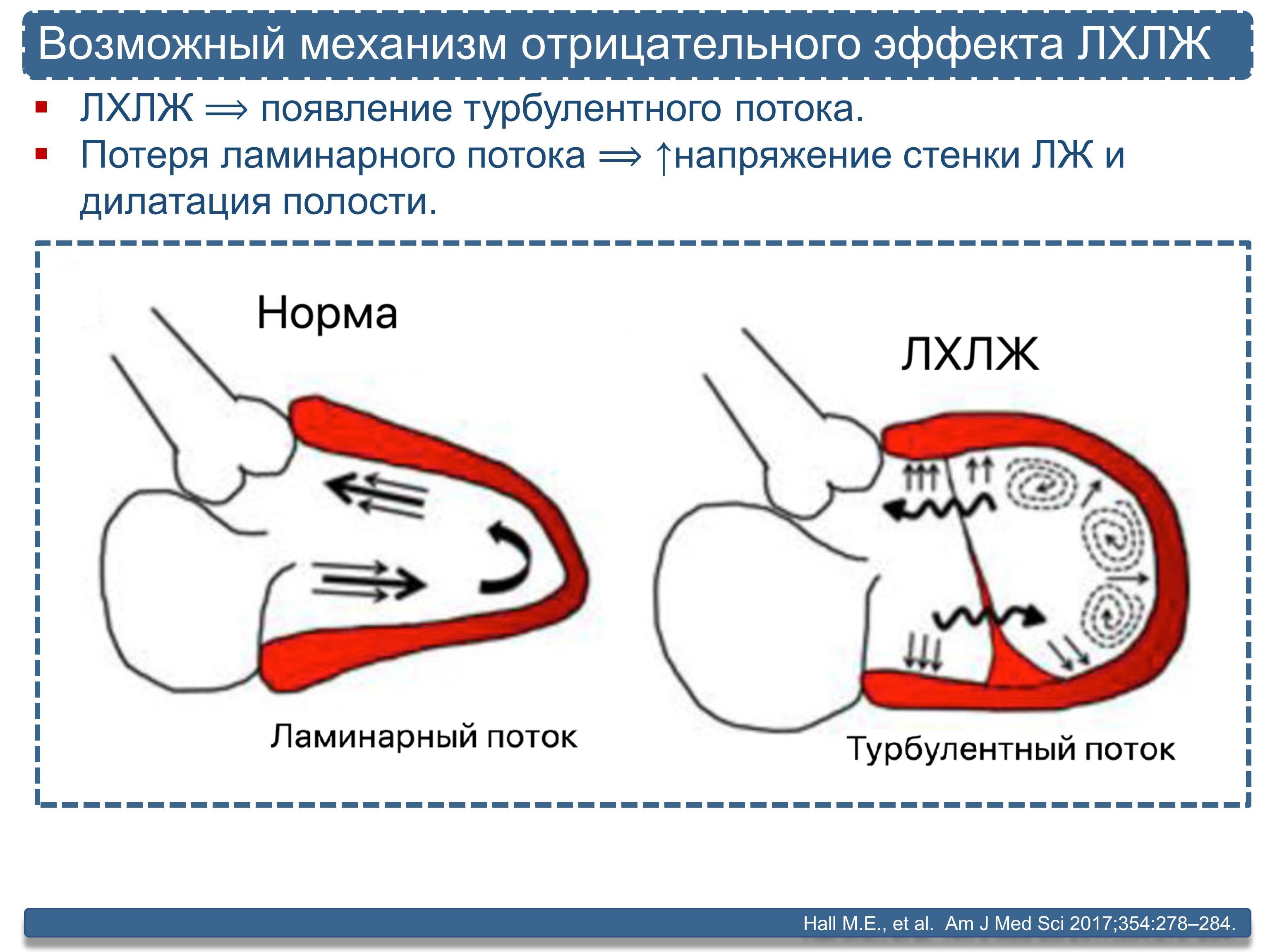 Дополнительная хорда в сердце у взрослого — сердце