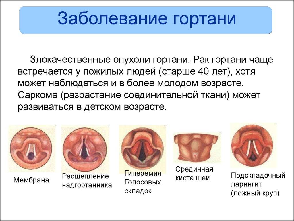 Рыхлое горло у детей с фото: что это значит, как выглядит и чем лечить?