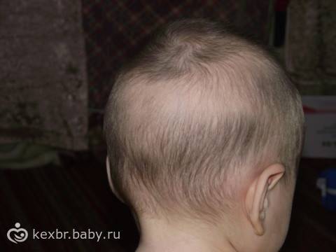Выпадение волос у детей: большая проблема малышей