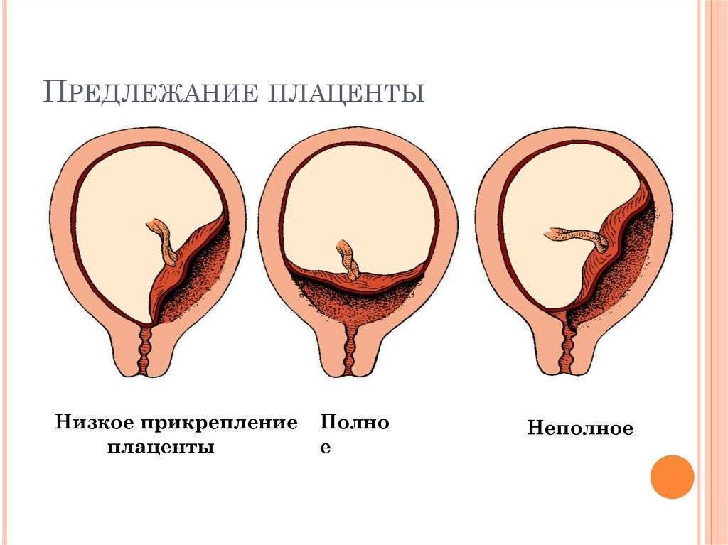 Расположение плаценты по передней стенке: особенности течения беременности и возможные риски