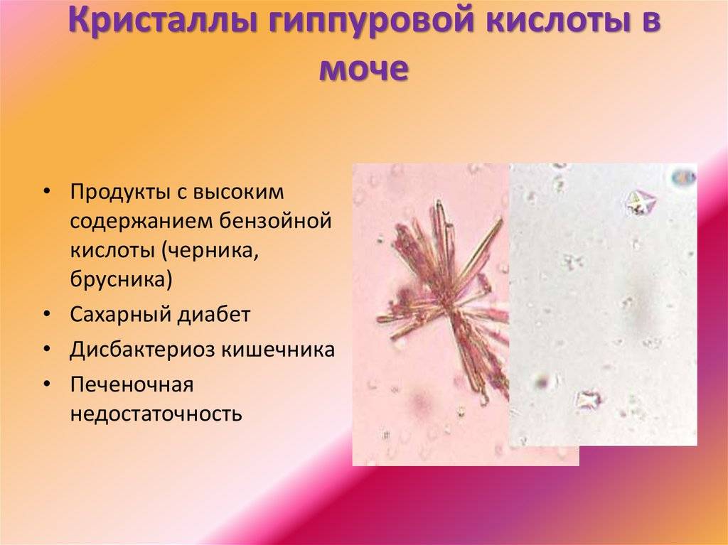 Фосфаты в моче у ребенка
