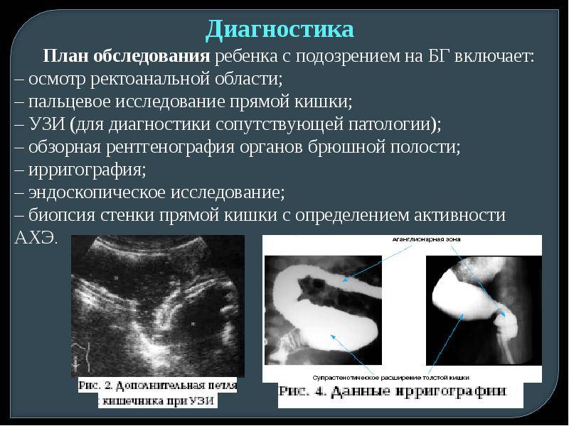 Болезнь Гиршпрунга у детей: симптомы, лечение и возможные последствия для новорожденных