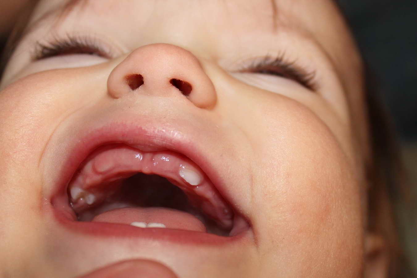 Прорезывание зубов у детей – симптомы, что нужно знать