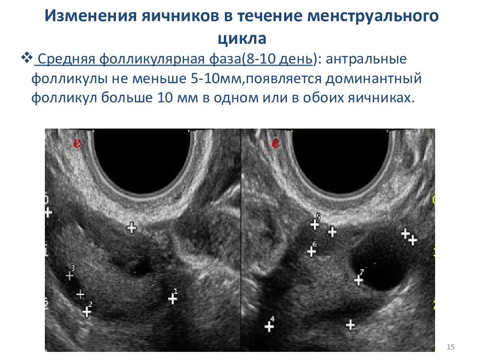 Доминантный фолликул в правом яичнике что это. Функции фолликулов яичника. Мониторинг созревания фолликулов УЗИ. Фолликулы в яичниках 10 мм это норма.