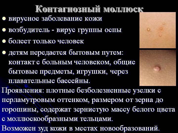 Контагиозный моллюск у детей: фото на коже, лечение и удаление на разных стадиях болезни
