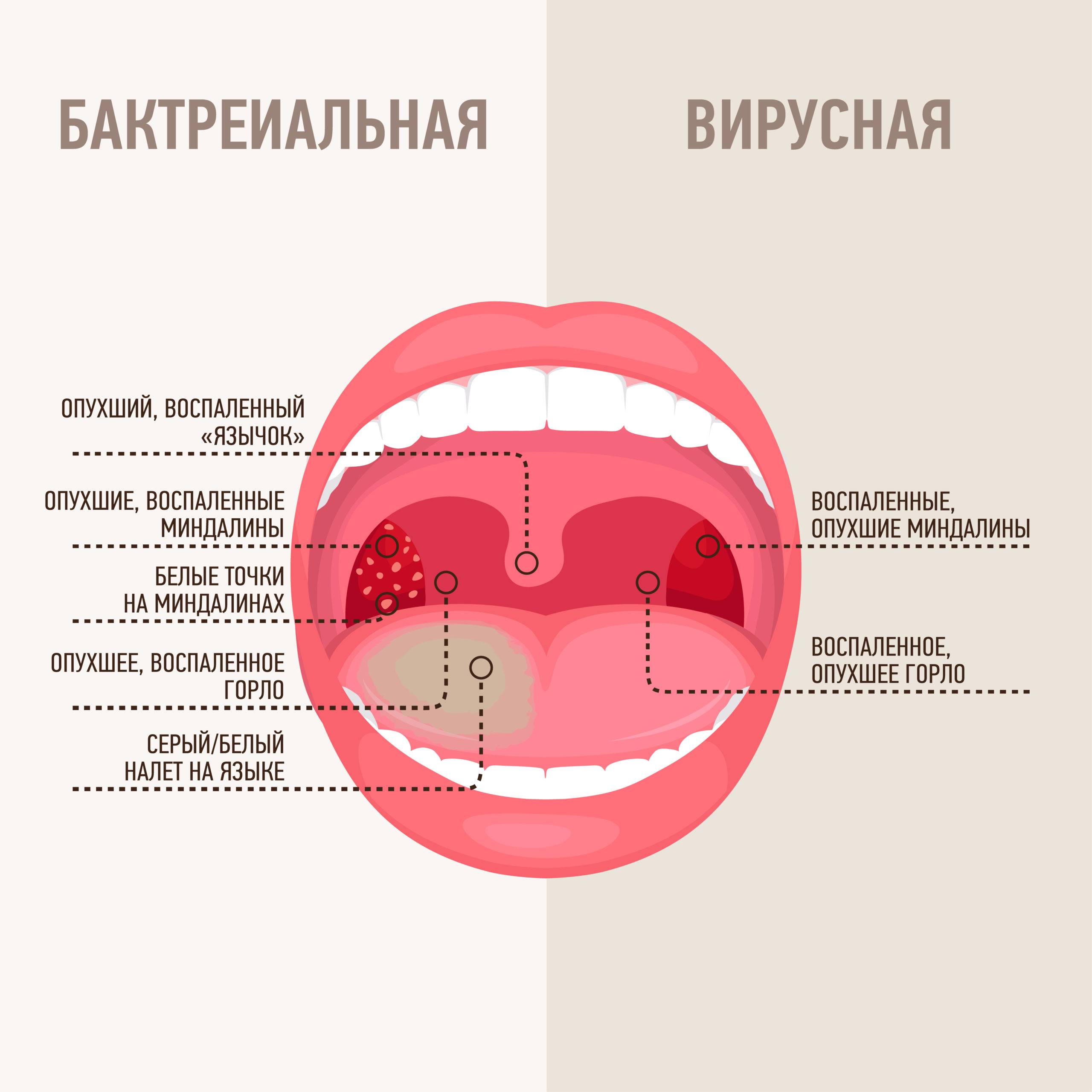 ангина у ребенка фото горла и языка