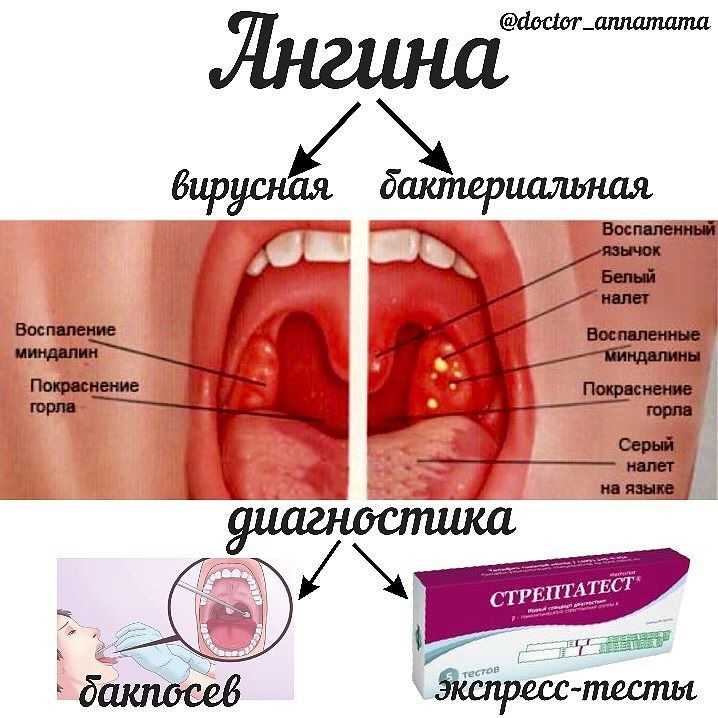 Бактериальная ангина: симптомы, причины, диагностика и фото горла
