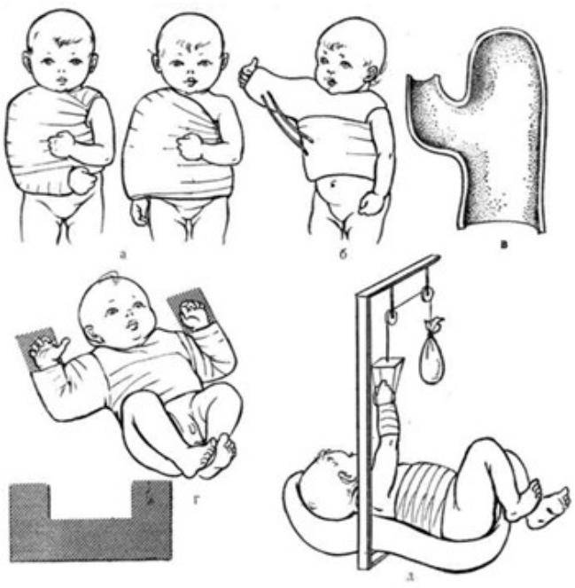 Перелом ключицы у новорожденного при родах: последствия для ребенка