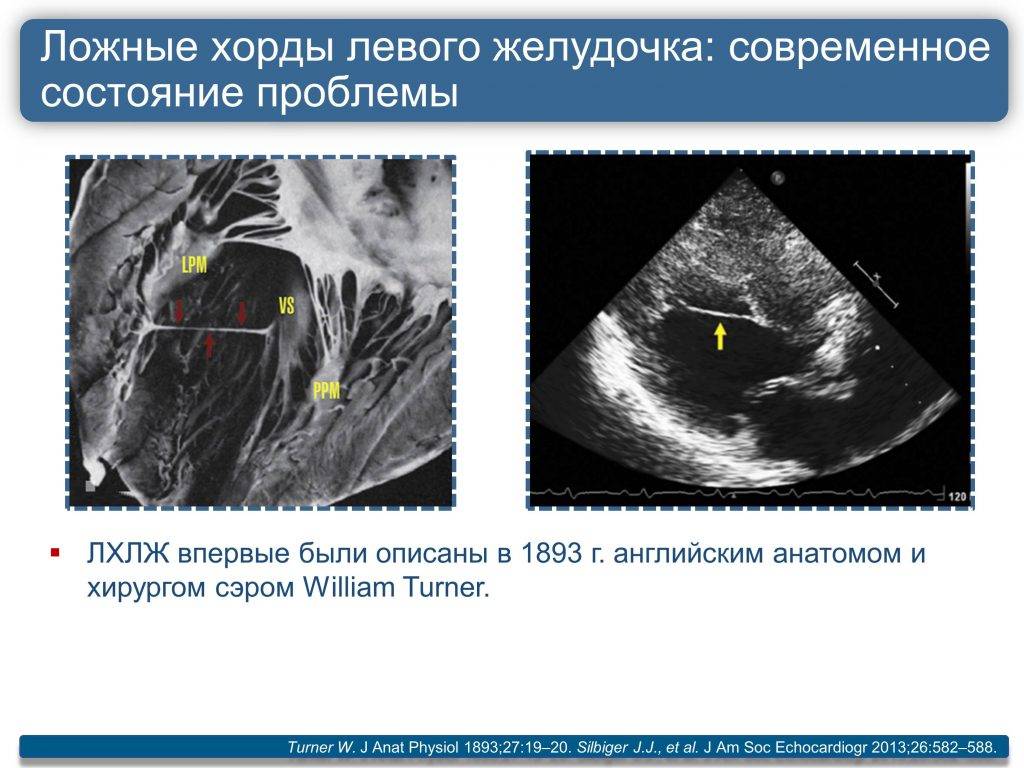 Дополнительная хорда в сердце у ребенка, чем опасны хорды в сердце