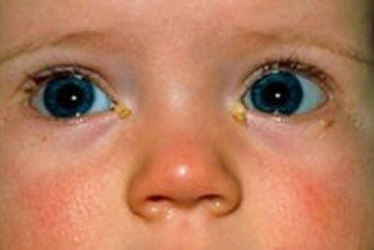 У ребенка закисают глаза: почему так происходит и что делать родителям