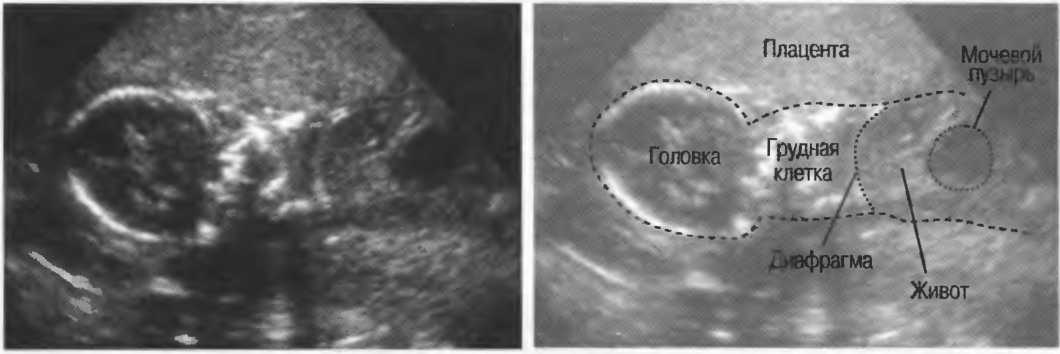 Повышенный тонус матки: симптомы в 1, 2 и 3 триместре. как снять гипертонус матки при беременности?