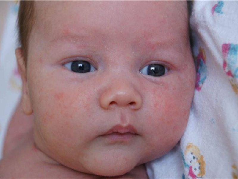 Как проявляется пищевая аллергия у новорождённого и как лечить сыпь на лице у грудничка