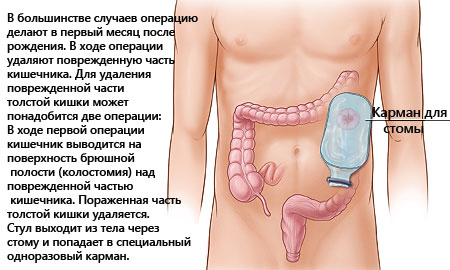 Болезнь гиршпрунга  – аганглиоз