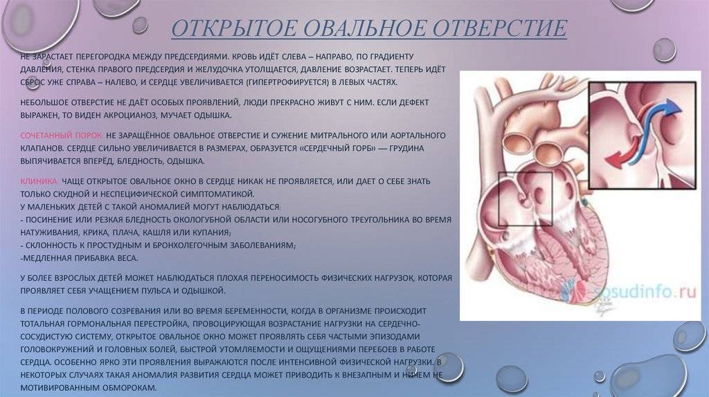 Овальное окно в сердце у новорожденного