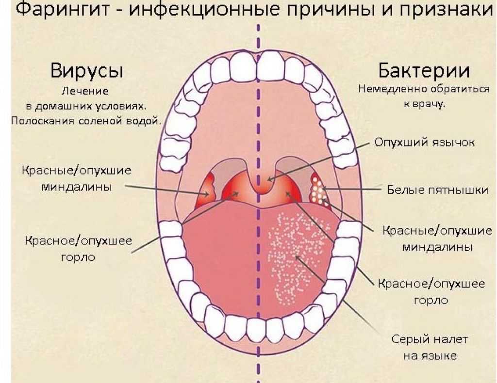 Герпес в горле у ребенка, фото | вирус герпес