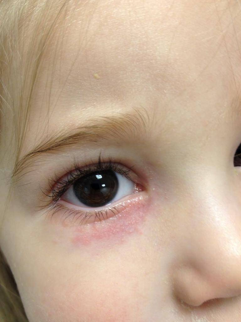 Красное пятно у ребенка на лице: причины и лечение